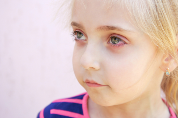Red Eyes in Children