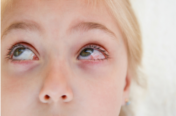 Red Eyes in Children